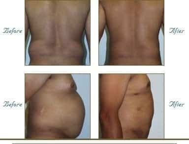 liposuction1-img-blog