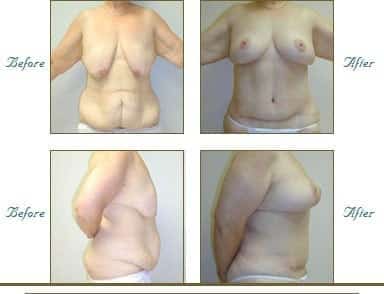 tummyTuck1-img-blog