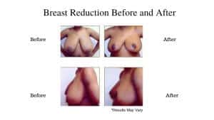A woman before and after her breast reduction surgery in High Point, NC. Breast reduction surgery can eliminate the pain and discomfort associated with breasts that are naturally overly large.