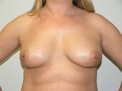 Breast Augmentation Patient Before 5