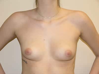 Breast Augmentation Patient Before 3