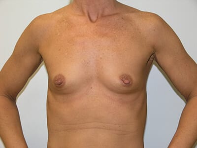 Breast Augmentation Patient Before 1