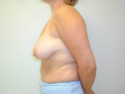 Breast Lift Patient Before 1 - 2