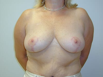 Breast Lift Patient After 1