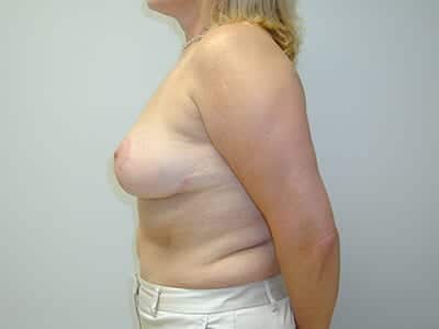 Breast Lift Patient After 1 - 2