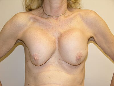 Breast Revision Patient Before 1