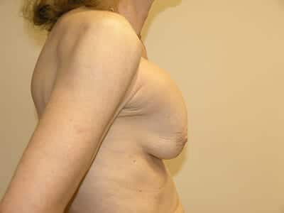 Breast Revision Patient Before 1 - 2