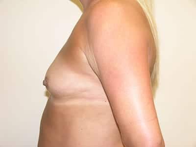Breast Augmentation Patient Before 2 - 2