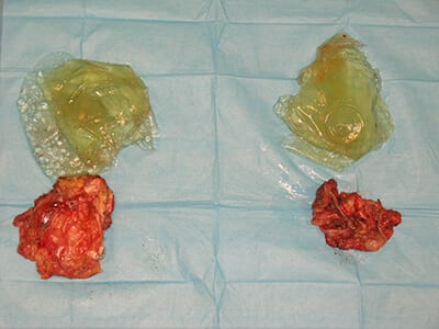Breast Revision Implants