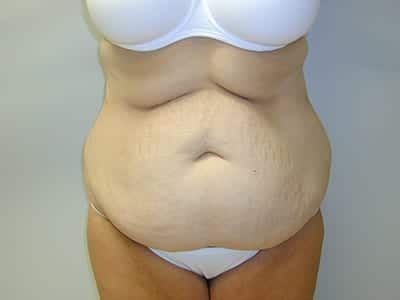 Tummy Tuck Before Patient 1