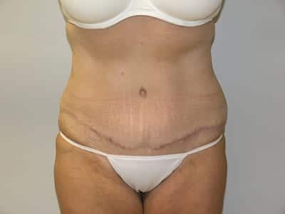 Tummy Tuck After Patient 1