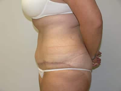 Tummy Tuck After Patient 1 - 2