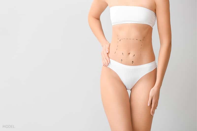 Slim woman in white underwear with liposuction lines drawn on abdomen.