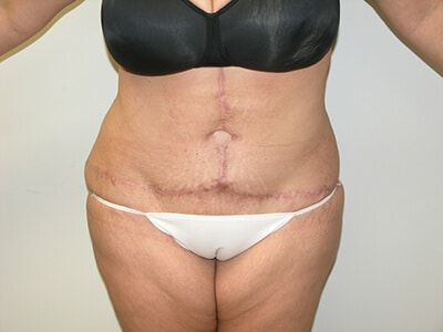 Tummy Tuck After Patient 2