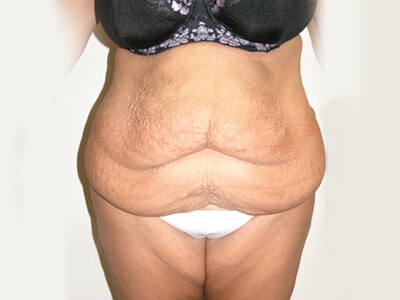 Tummy Tuck Before Patient 2