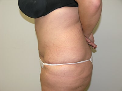 Tummy Tuck After Patient 2 - 2