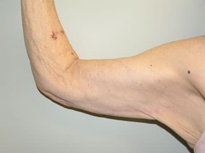 Arm Lift (Brachioplasty) After Patient 1