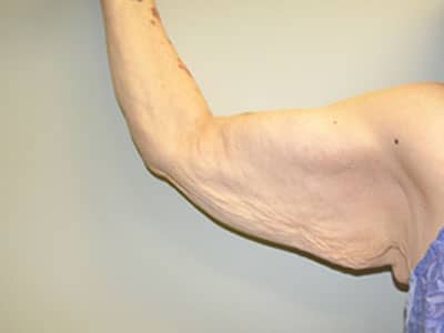 Arm Lift (Brachioplasty) Before Patient 1
