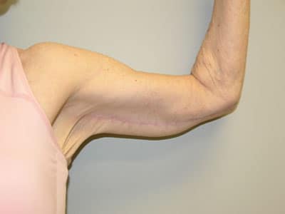 Arm Lift (Brachioplasty) After Patient 1