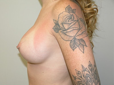 Breast Augmentation Patient 6 After 2