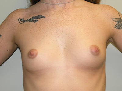 Breast Augmentation Patient 6 Before