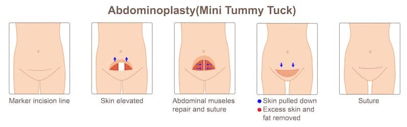 Illustration of how a mini tummy tuck is performed.