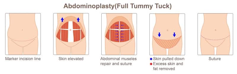Illustration of how a tummy tuck is performed.