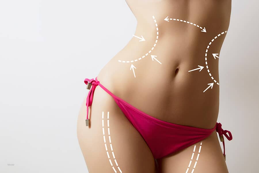 Marks on a woman's abdomen and thighs indicated where she has had liposuction to improve her body contours.