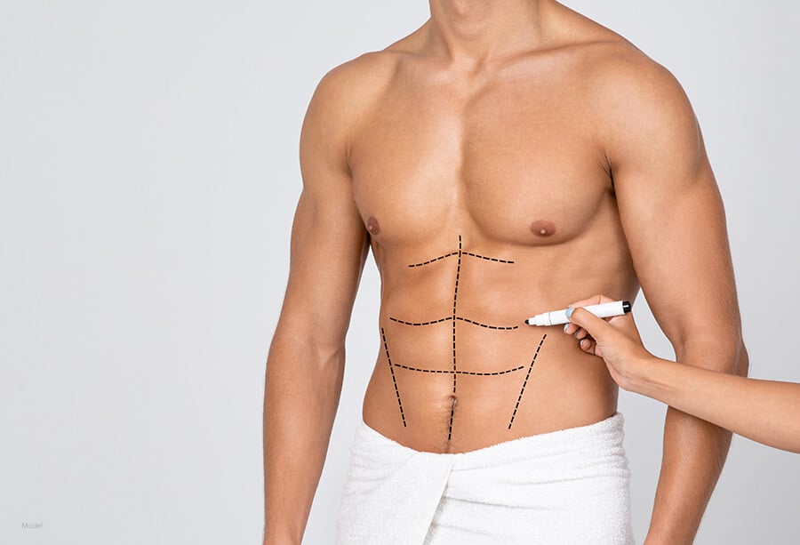 A man has his abdominal muscles marked up before undergoing liposuction to add definition.
