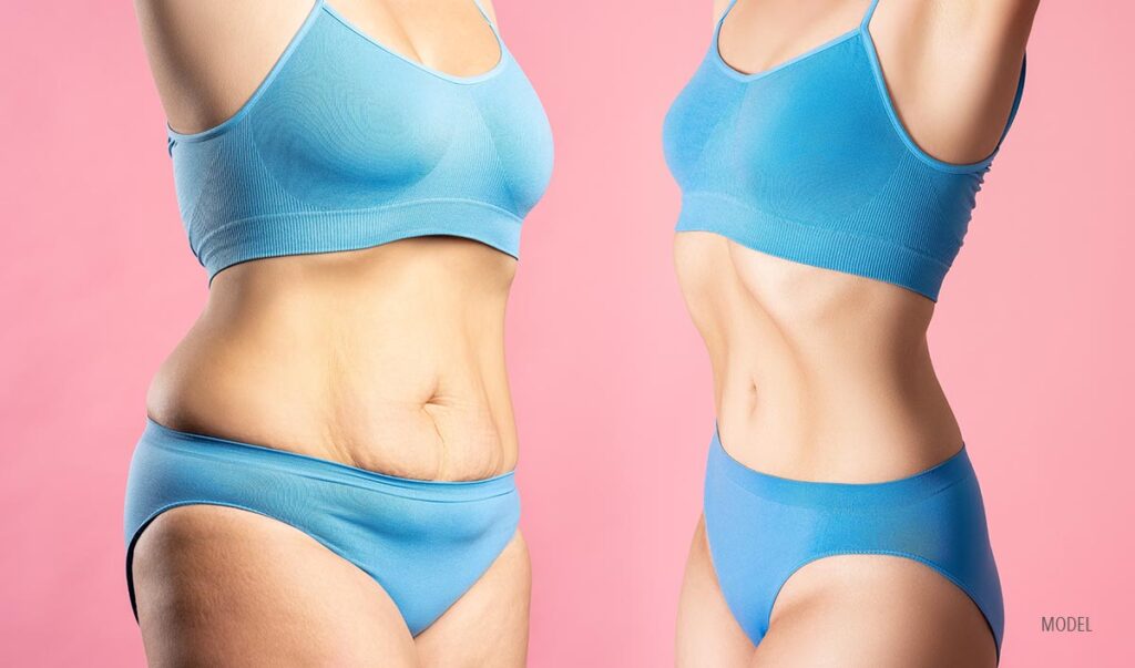 A tummy tuck before and after pic featuring a woman in a blue bra and underwear.